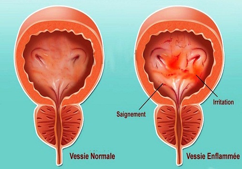 Viêm bàng quang mãn tính có nguy hiểm không? Có chữa được không?