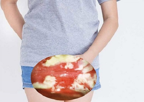 Âm đạo bị sưng tấy nguyên nhân là bệnh gì?
