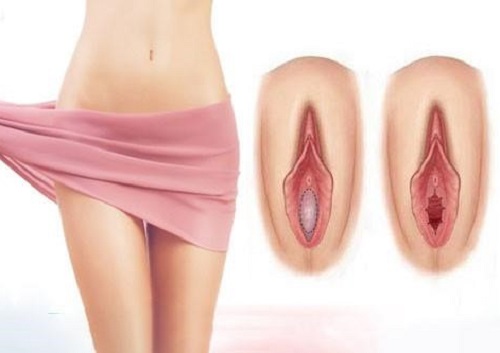 Những nguyên nhân làm rách màng trinh ở phụ nữ là gì?