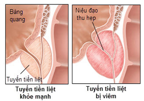 Tác hại bệnh viêm niệu đạo nhiều người không biết