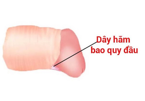 Đứt dây hãm bao quy đầu có nguy hiểm không? Cách xử lý