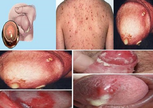 Top nguyên nhân tiểu rắt ở nam giới và cách khắc phục