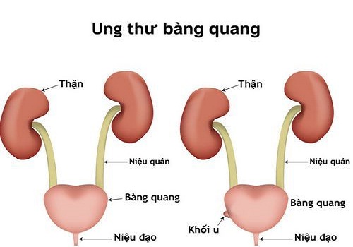 Top nguyên nhân tiểu ra máu ở nam giới không phải ai cũng biết