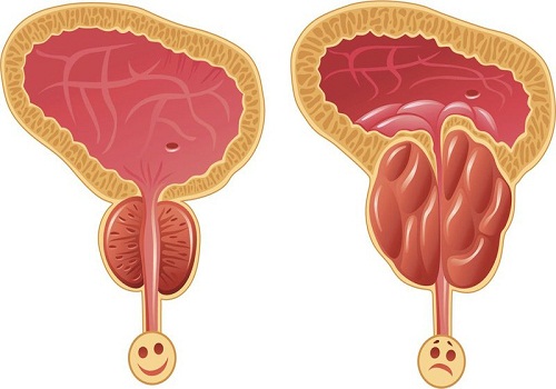 Top nguyên nhân bệnh liệt dương ở nam giới là gì?