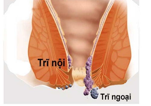 Nguyên nhân bị nứt kẽ hậu môn và cách chữa trị an toàn