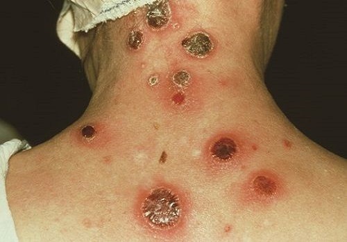 Các triệu chứng bệnh lậu giang mai và cách chữa trị