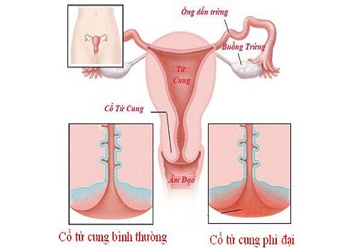 Triệu chứng của phì đại cổ tử cung ở phụ nữ