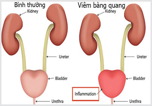 Nguyên nhân và triệu chứng viêm bàng quang ở nam giới