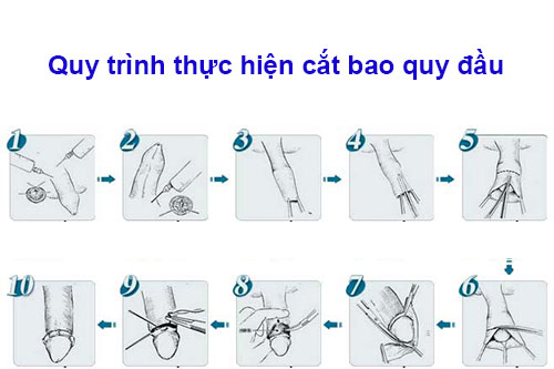 Quy trình cắt bao quy đầu bằng công nghệ xâm lấn tối thiểu