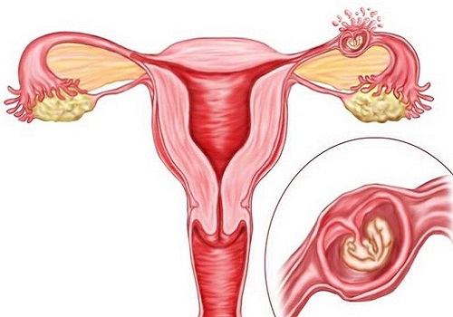 Bệnh viêm phần phụ là gì? Cách điều trị hiệu quả