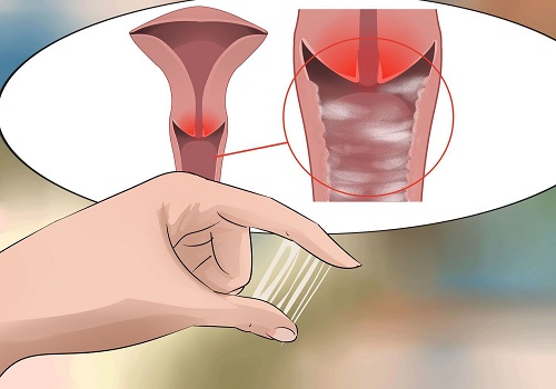 Nấm candida ở nữ: nguyên nhân, dấu hiệu và cách điều trị an toàn hiệu quả