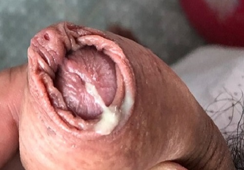 Dương vật chảy mủ trắng đục là dấu hiệu bệnh gì?