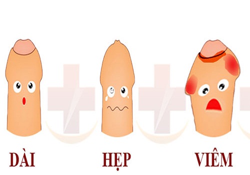 Viêm bao quy đầu cấp tính biểu hiện như thế nào? Cách chữa trị