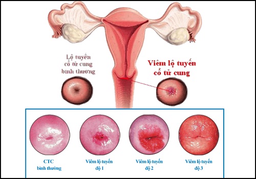 Viêm lộ tuyến cổ tử cung có cần đốt không?
