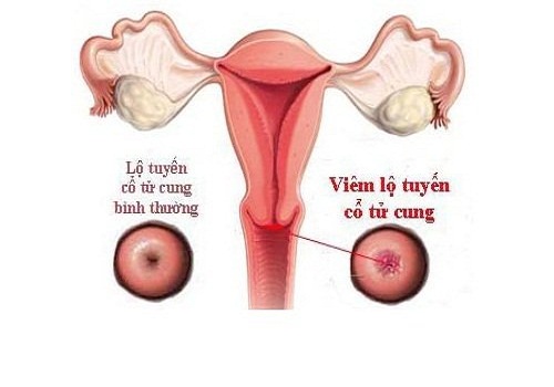 Cách phòng ngừa viêm lộ tuyến cổ tử cung ở nữ giới