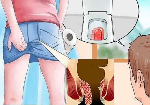 Điều trị bệnh trĩ hỗn hợp và một số lưu ý