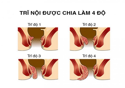 Bệnh trĩ nội: nguyên nhân, dấu hiệu và cách chữa trị