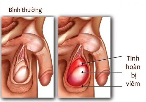 Đau và sưng tinh hoàn có phải là bị viêm tinh hoàn?