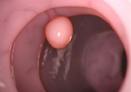 Polyp cổ tử cung: nguyên nhân, dấu hiệu và cách chữa trị