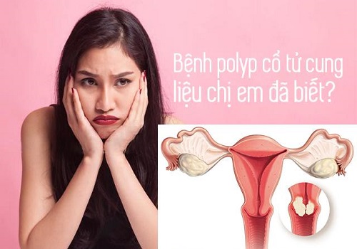 Polyp cổ tử cung: nguyên nhân, dấu hiệu và cách chữa trị