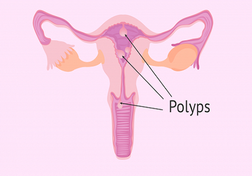 Các dấu hiệu nhận biết polyp cổ tử cung ở chị em