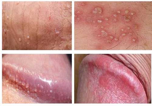 Bao quy đầu xuất hiện nhiều đốm đỏ là dấu hiệu gì?