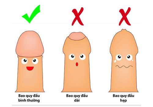Dài bao quy đầu không cắt có sao không? Chuyên gia giải đáp