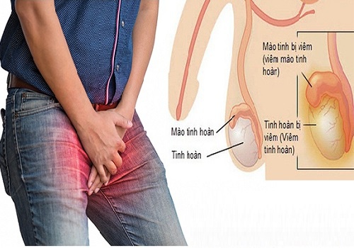 Viêm mào tinh hoàn ở nam giới có gây vô sinh không? Chuyên gia chia sẻ
