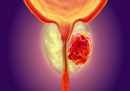 Vôi hóa tuyến tiền liệt có nguy hiểm không? Bác sĩ giải đáp