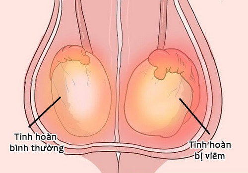 Dấu hiệu - triệu chứng - biểu hiện viêm tinh hoàn ở nam giới