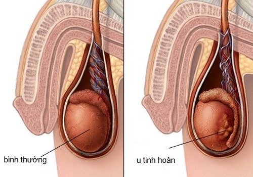 Bị đau tinh hoàn và bụng dưới ở nam giới là dấu hiệu bệnh gì?