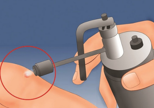 Chi phí đốt laser sùi mào gà hết bao nhiêu tiền?