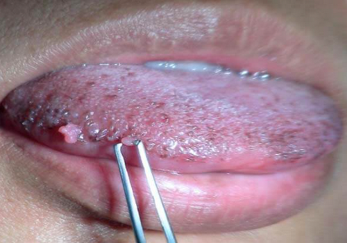 Sùi mào gà ở cổ họng