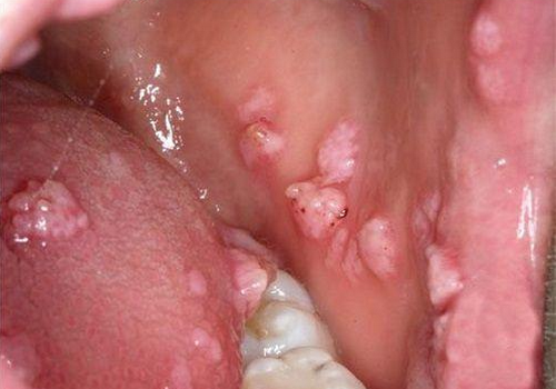 Sùi mào gà ở cổ họng