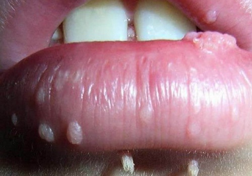 Sùi mào gà ở miệng: Hình ảnh - dấu hiệu - triệu chứng - biểu hiện và cách chữa trị