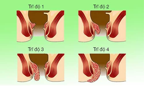 4 cấp độ của bệnh trĩ.