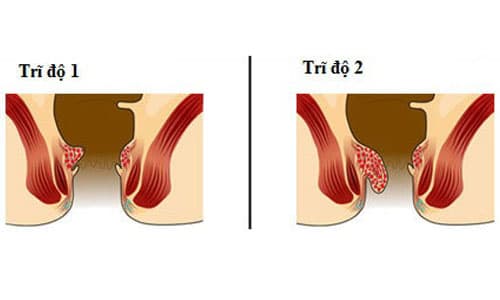 Hình ảnh bệnh trĩ nội độ 1 và độ 2