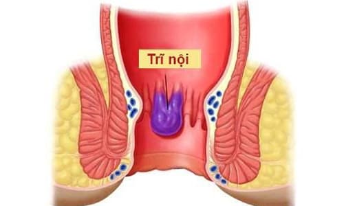 Hình ảnh bệnh trĩ nội