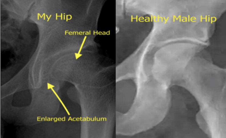 X-Rays of Will's hip injuries
