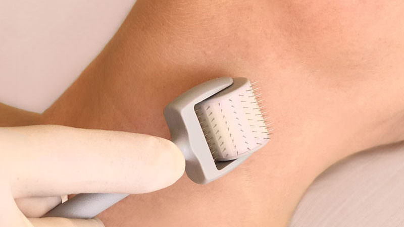 Microneedling (Induktionstherapie)