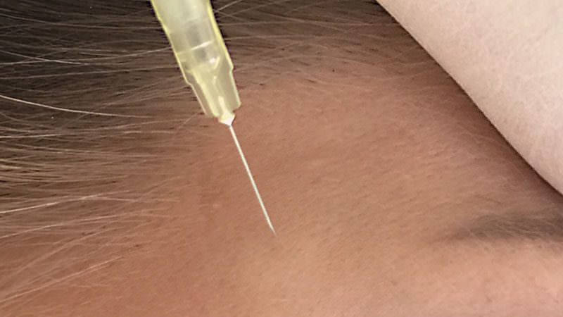 Faltenbehandlung – Botulinumtoxin