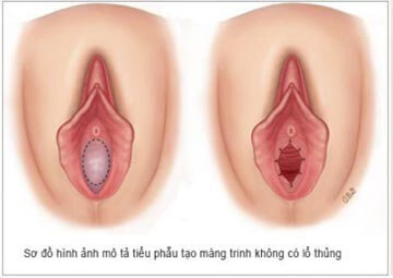 Hình ảnh màng trinh không lỗ