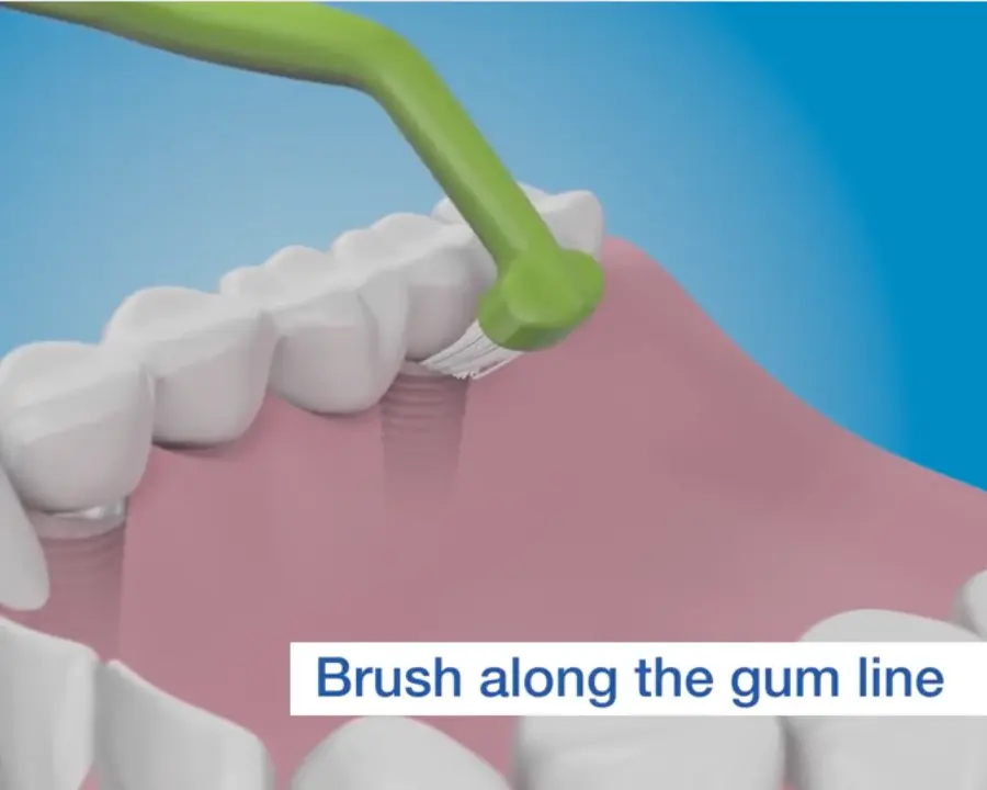 illustration of properly brushing dental implant around dental implants