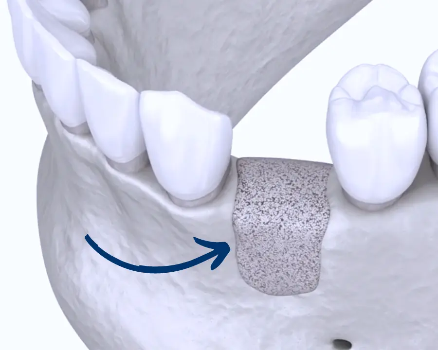 Illustration of dental bone grafting placed on a single tooth site