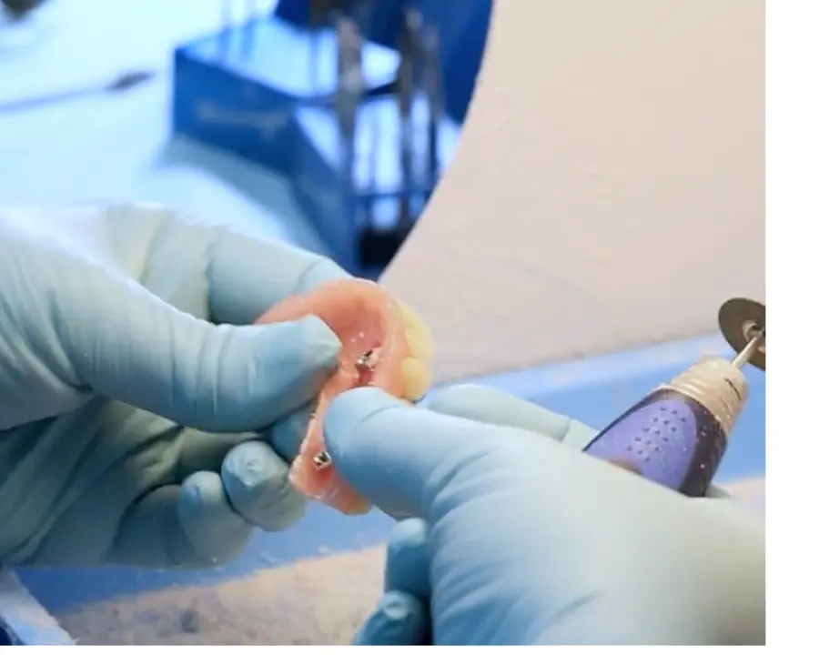 Teeth in a day being created manually from acrylic dentures.