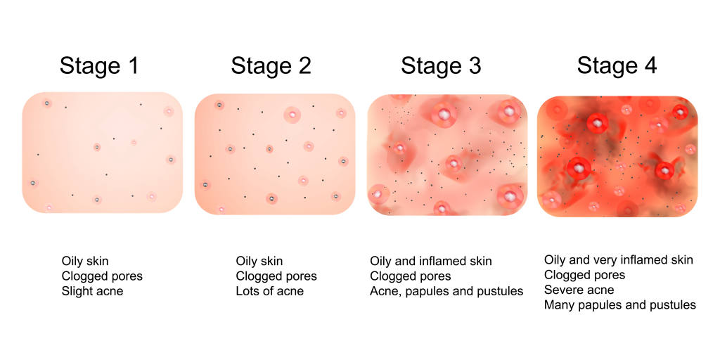 Stages of Acne Development
