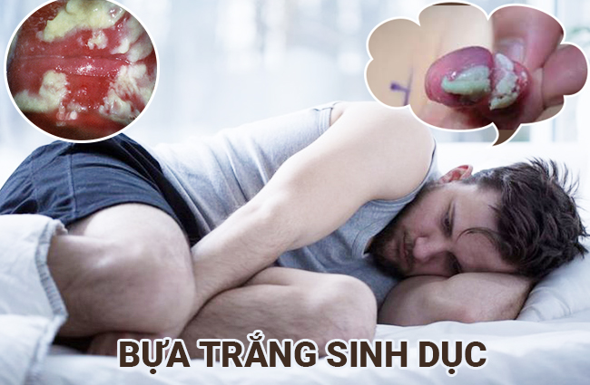 Dương vật có bựa trắng