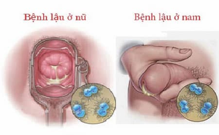 Khám bệnh lậu ở vĩnh phúc