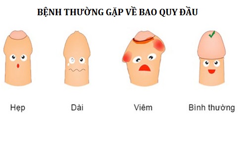 Bệnh dài bao quy đầu