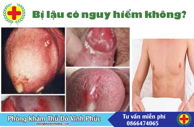 Bệnh lậu có nguy hiểm không?